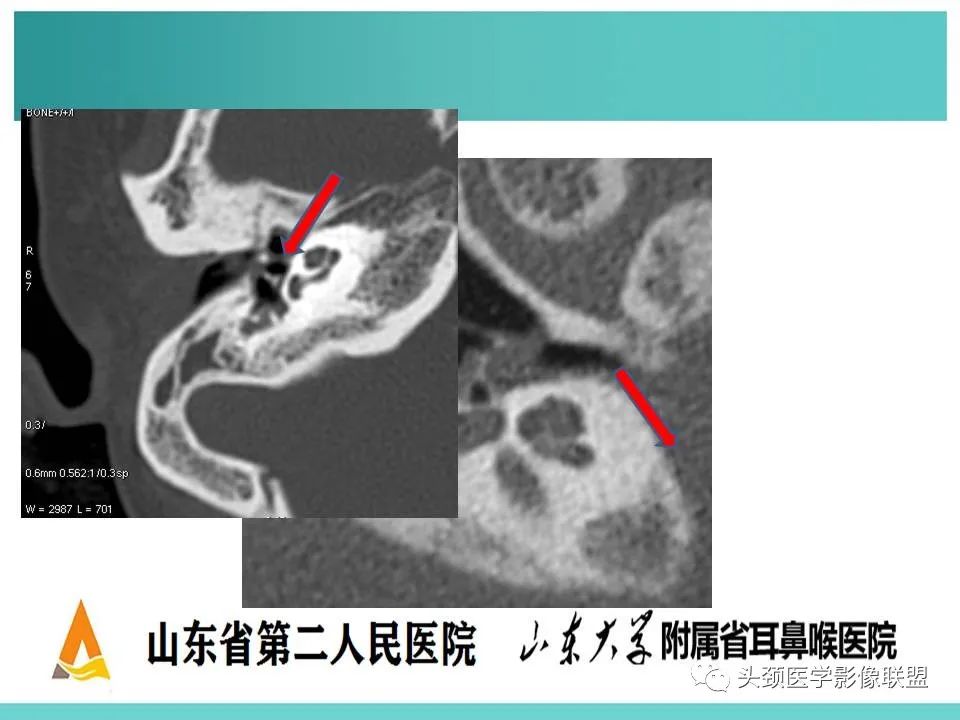 影像PPT - 【PPT】慢性中耳乳突炎-35