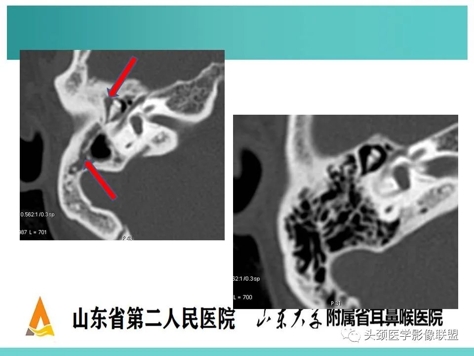 影像PPT - 【PPT】慢性中耳乳突炎-34