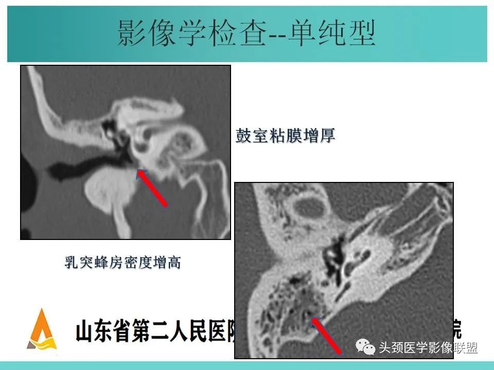 影像PPT - 【PPT】慢性中耳乳突炎-36
