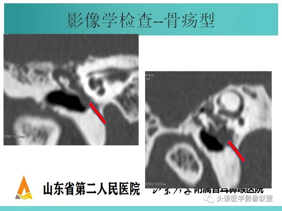 影像PPT - 【PPT】慢性中耳乳突炎-38
