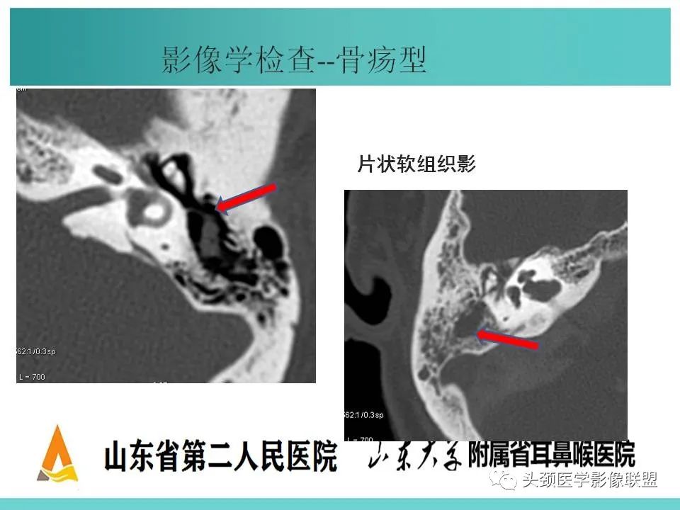 影像PPT - 【PPT】慢性中耳乳突炎-37