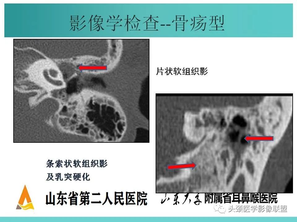 影像PPT - 【PPT】慢性中耳乳突炎-39