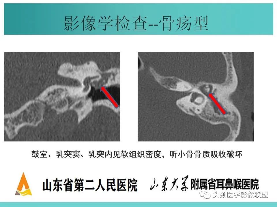 影像PPT - 【PPT】慢性中耳乳突炎-41