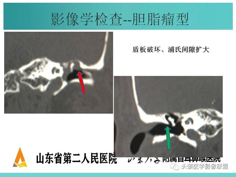 影像PPT - 【PPT】慢性中耳乳突炎-42
