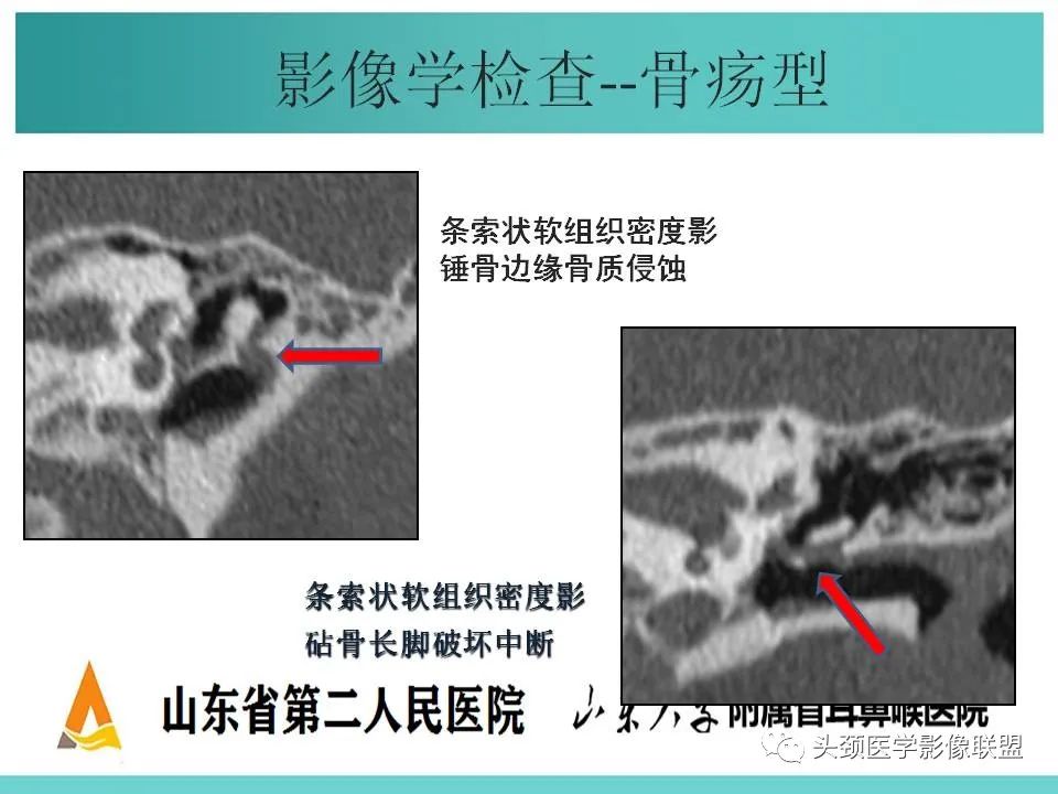 影像PPT - 【PPT】慢性中耳乳突炎-40