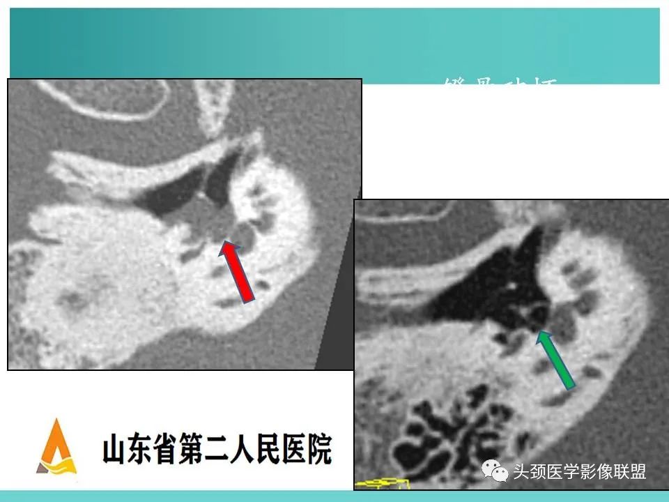 影像PPT - 【PPT】慢性中耳乳突炎-45