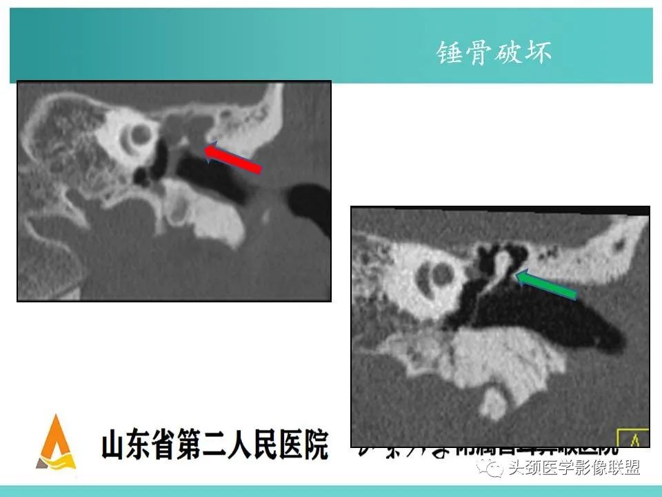 影像PPT - 【PPT】慢性中耳乳突炎-43
