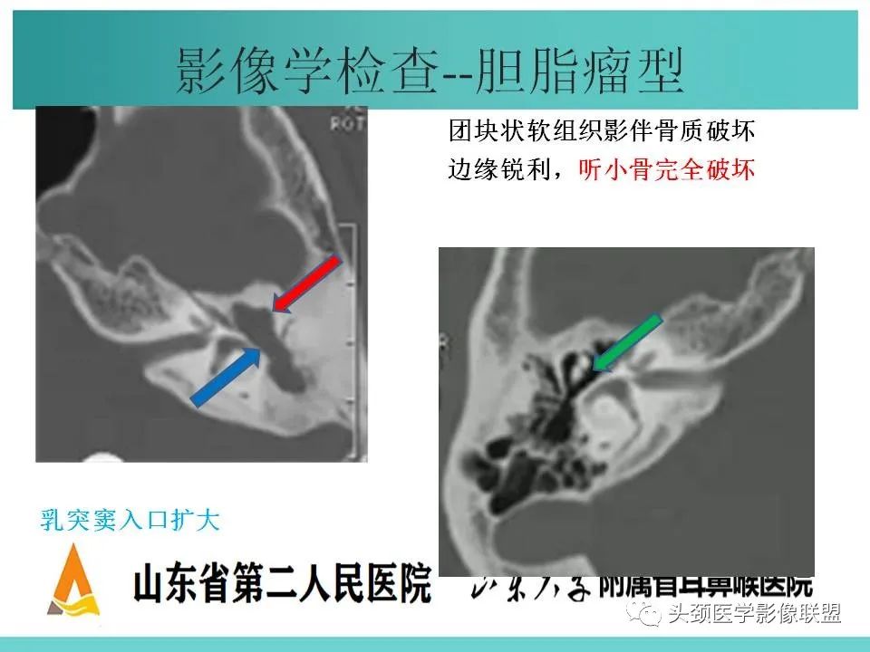 影像PPT - 【PPT】慢性中耳乳突炎-47