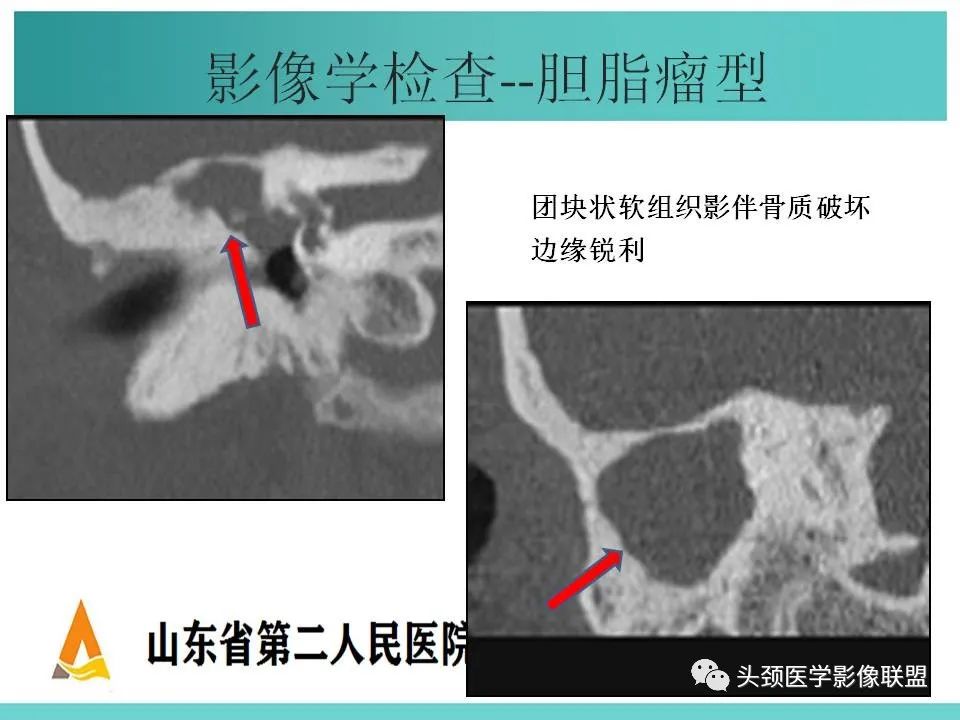 影像PPT - 【PPT】慢性中耳乳突炎-46