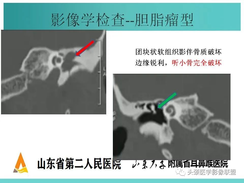 影像PPT - 【PPT】慢性中耳乳突炎-48