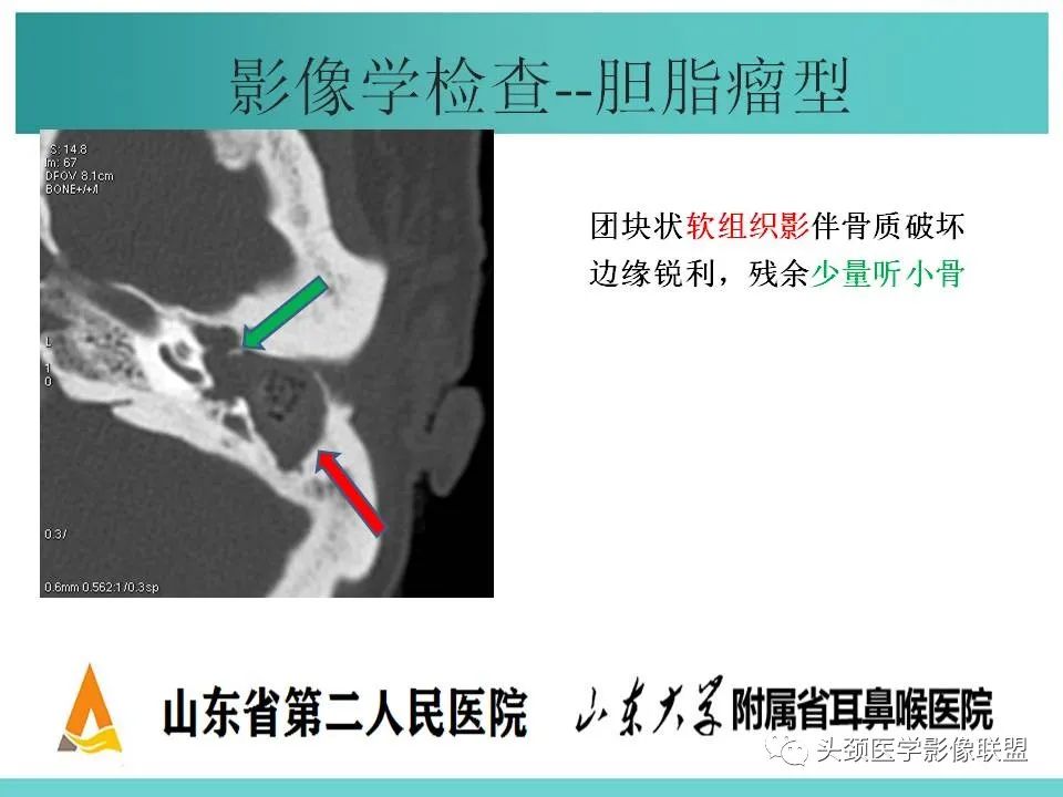 影像PPT - 【PPT】慢性中耳乳突炎-49