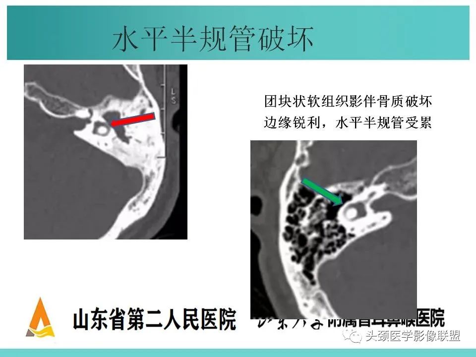 影像PPT - 【PPT】慢性中耳乳突炎-51