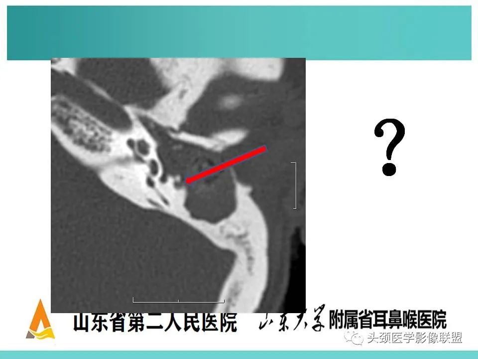 影像PPT - 【PPT】慢性中耳乳突炎-50