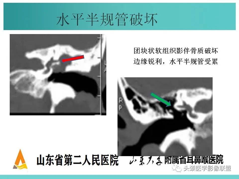 影像PPT - 【PPT】慢性中耳乳突炎-52