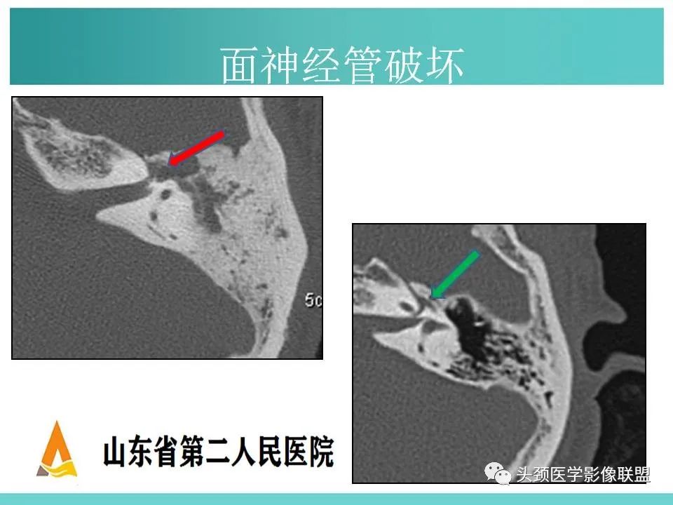 影像PPT - 【PPT】慢性中耳乳突炎-53