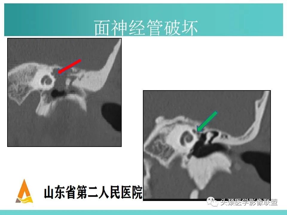 影像PPT - 【PPT】慢性中耳乳突炎-54