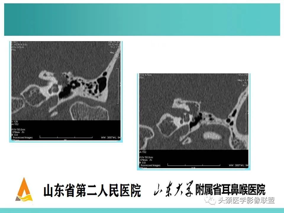 影像PPT - 【PPT】慢性中耳乳突炎-56