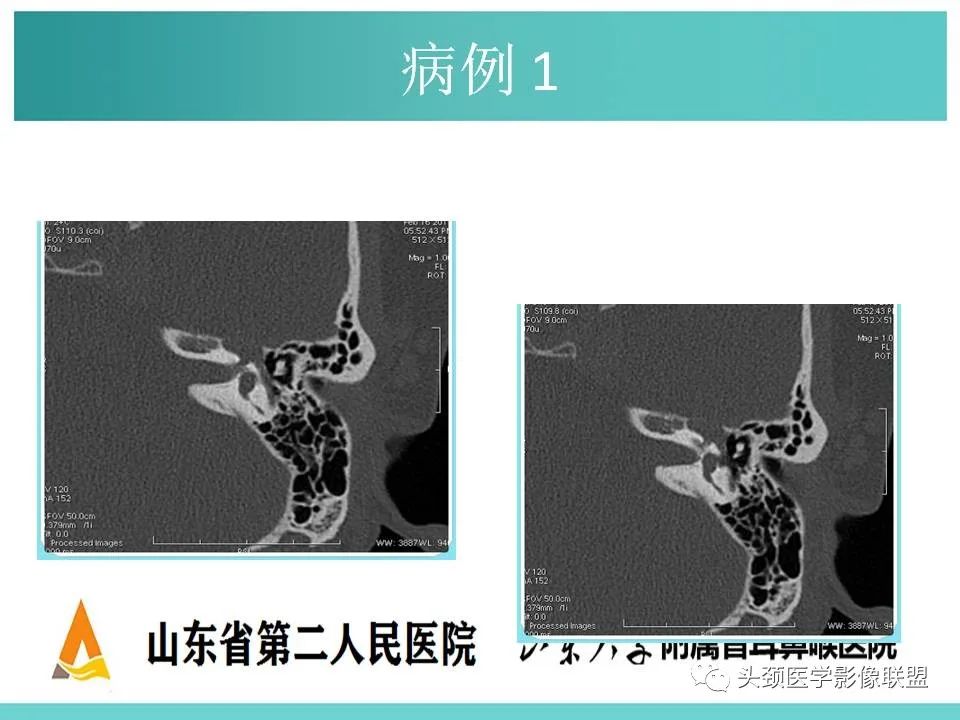 影像PPT - 【PPT】慢性中耳乳突炎-55