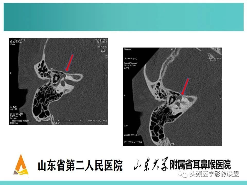 影像PPT - 【PPT】慢性中耳乳突炎-57