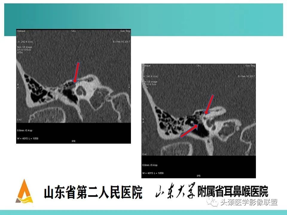 影像PPT - 【PPT】慢性中耳乳突炎-58