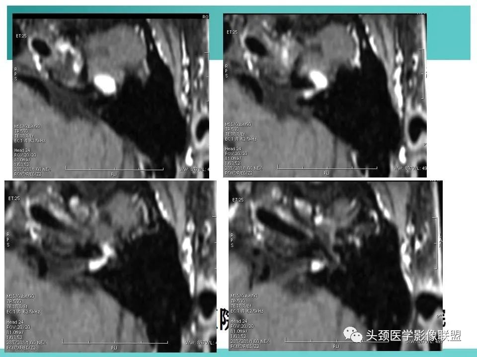 影像PPT - 【PPT】慢性中耳乳突炎-61