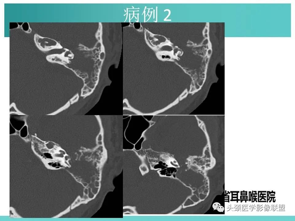 影像PPT - 【PPT】慢性中耳乳突炎-63