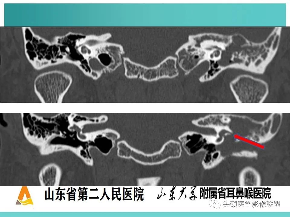 影像PPT - 【PPT】慢性中耳乳突炎-66