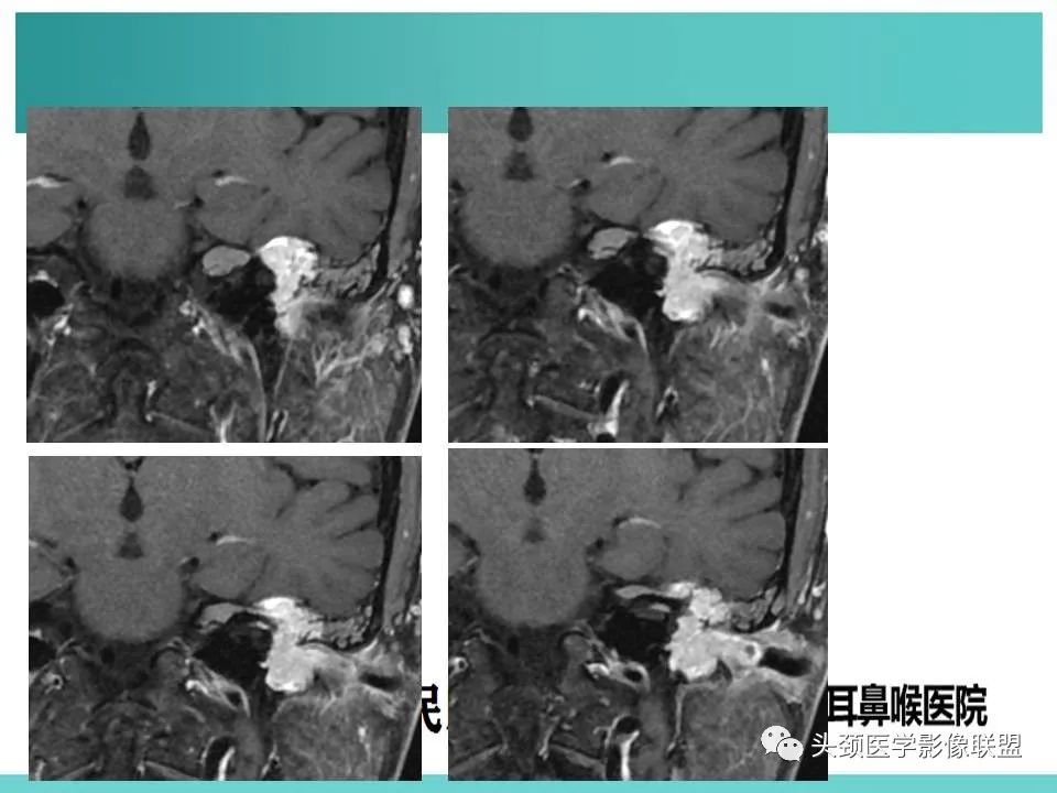 影像PPT - 【PPT】慢性中耳乳突炎-67
