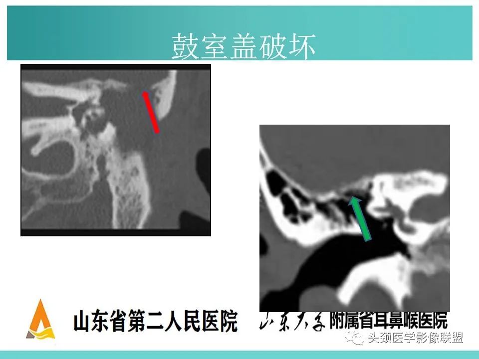 影像PPT - 【PPT】慢性中耳乳突炎-70
