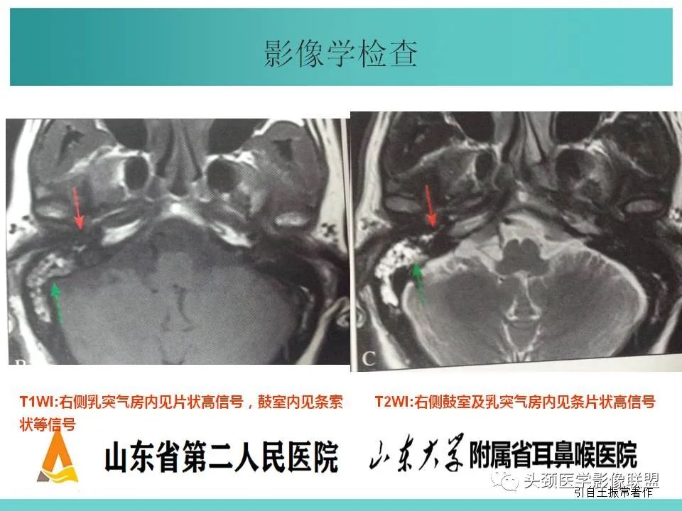 影像PPT - 【PPT】慢性中耳乳突炎-73