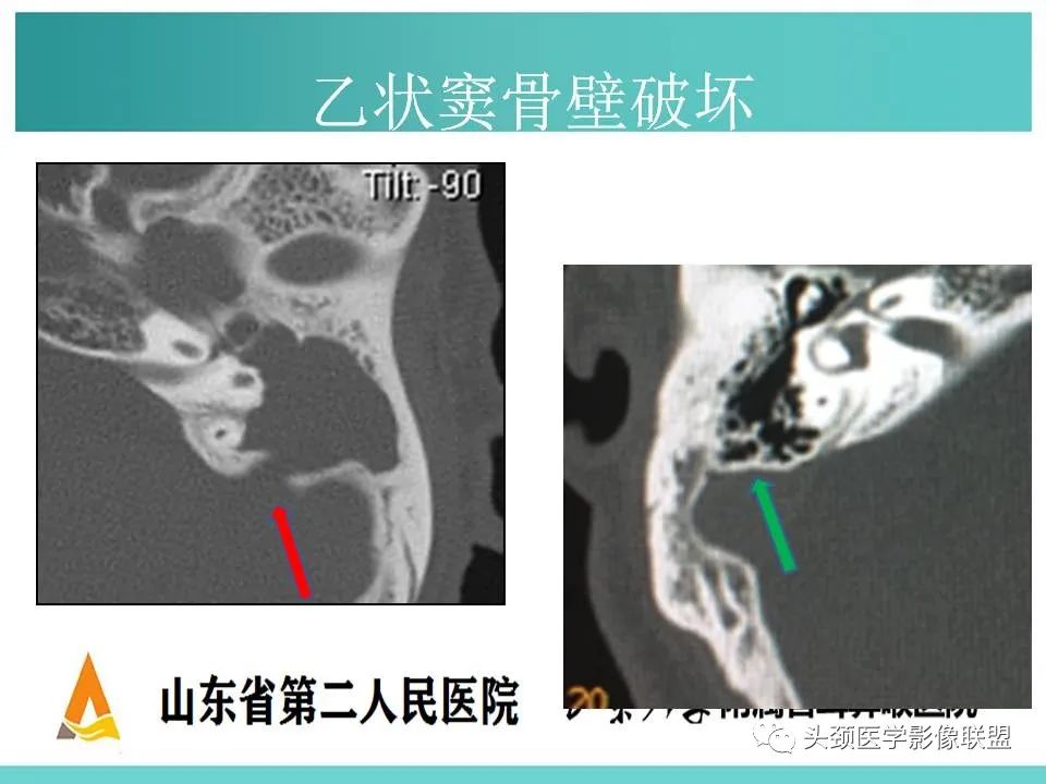 影像PPT - 【PPT】慢性中耳乳突炎-71