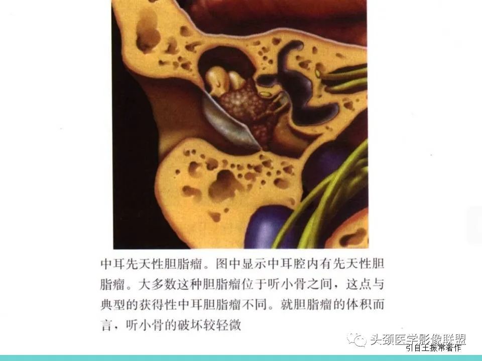 影像PPT - 【PPT】慢性中耳乳突炎-77
