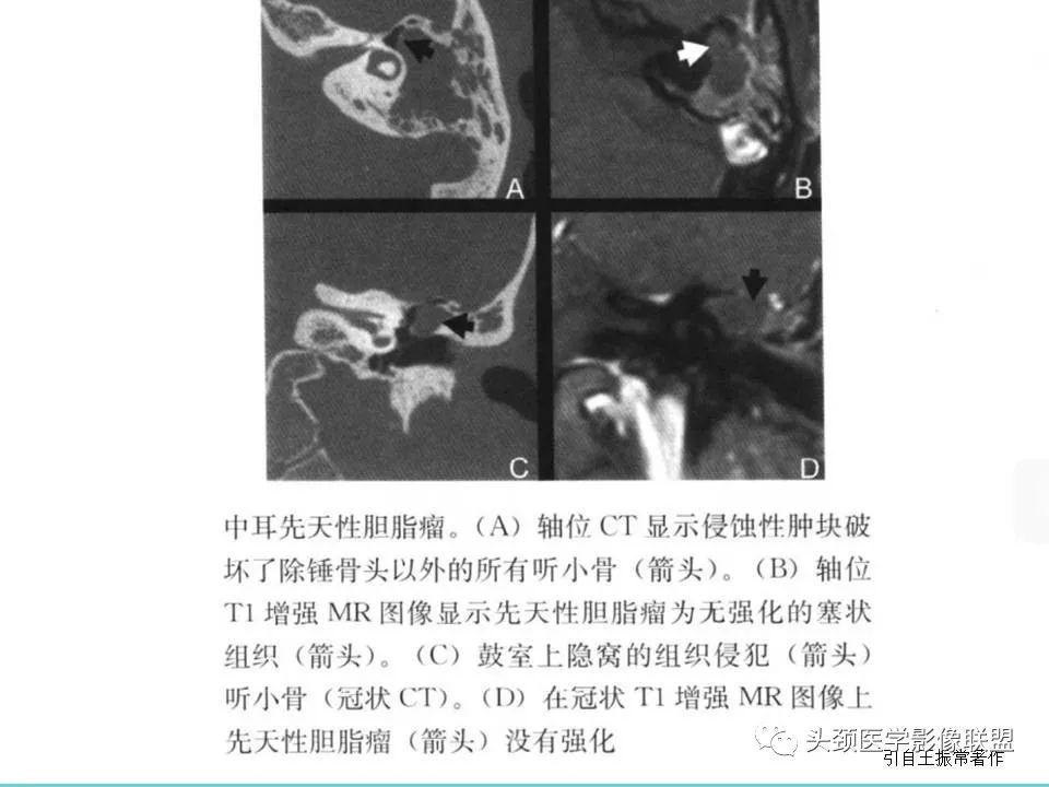 影像PPT - 【PPT】慢性中耳乳突炎-78