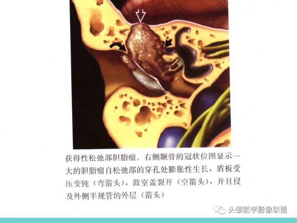 影像PPT - 【PPT】慢性中耳乳突炎-80