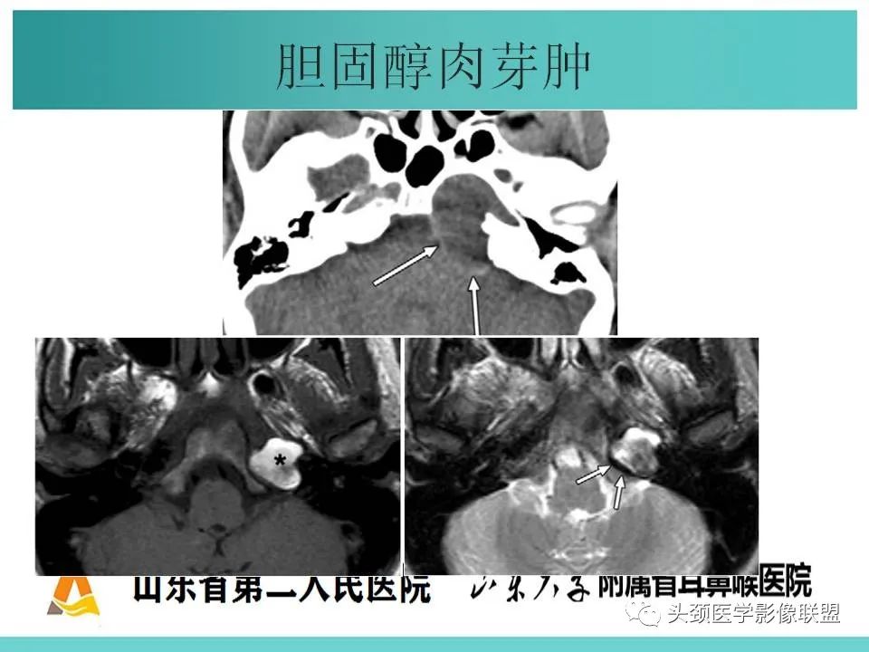 影像PPT - 【PPT】慢性中耳乳突炎-85