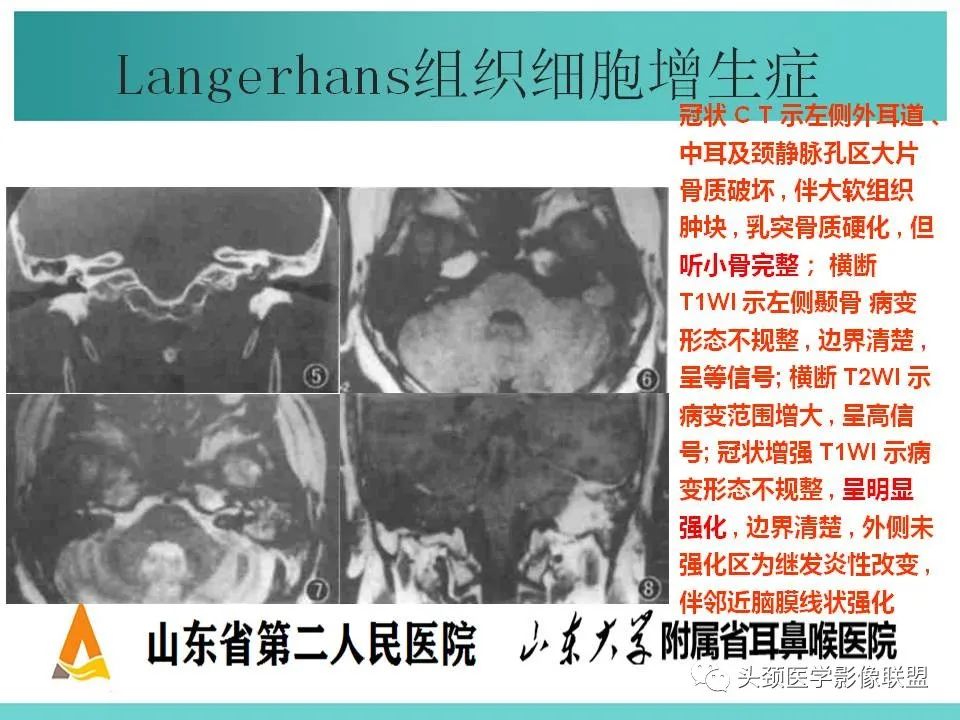影像PPT - 【PPT】慢性中耳乳突炎-87