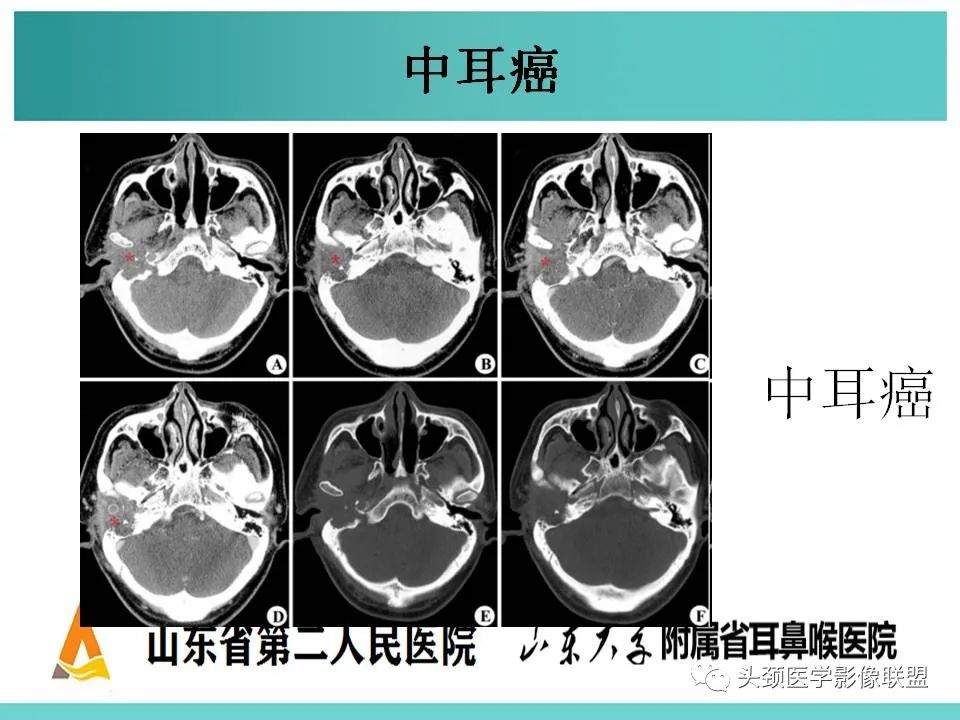 影像PPT - 【PPT】慢性中耳乳突炎-92