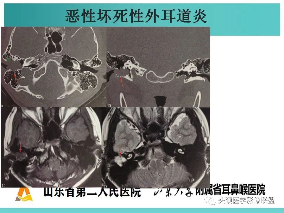 影像PPT - 【PPT】慢性中耳乳突炎-90