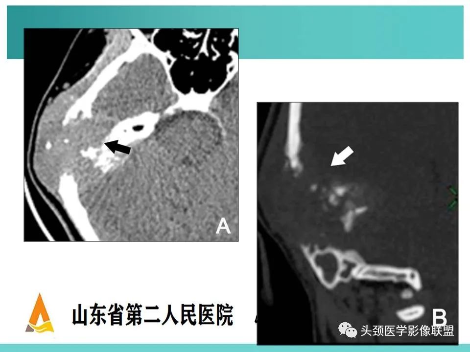 影像PPT - 【PPT】慢性中耳乳突炎-95