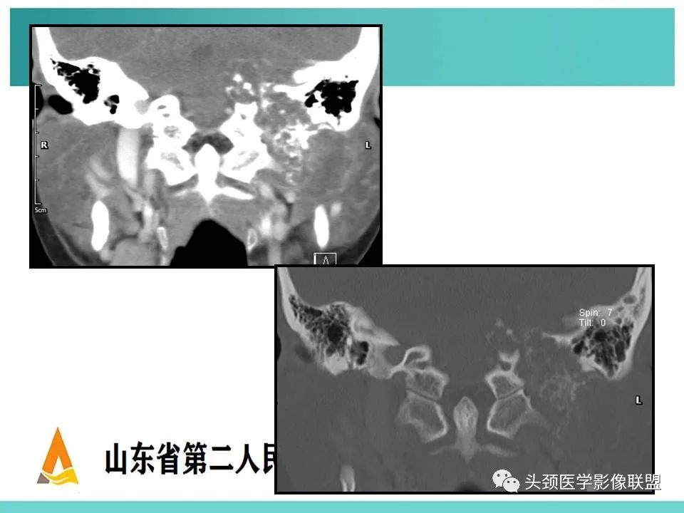 影像PPT - 【PPT】慢性中耳乳突炎-94