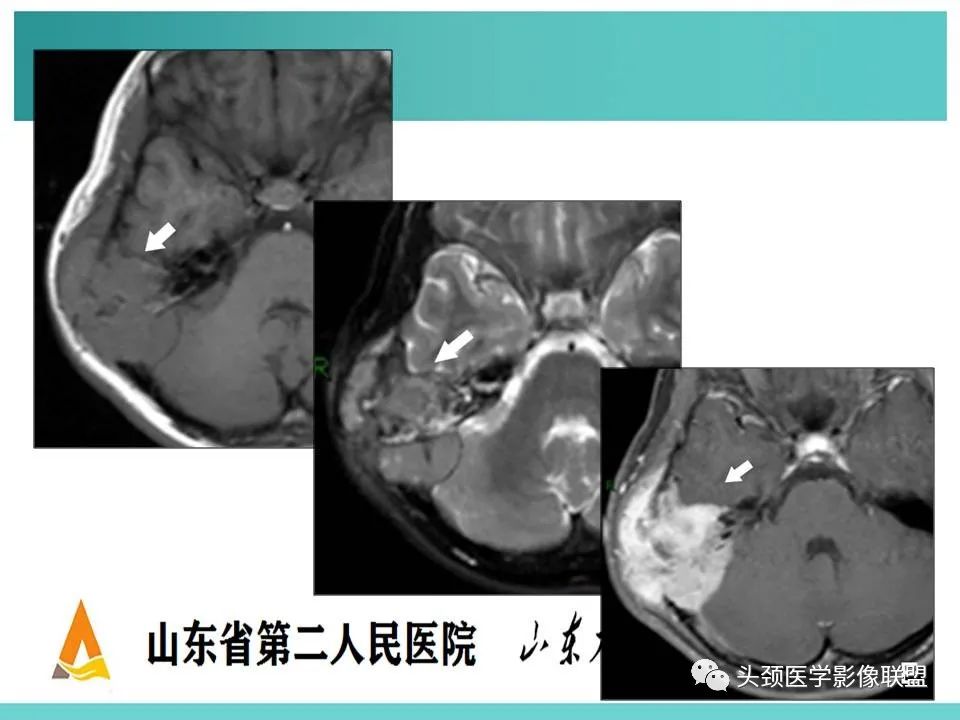 影像PPT - 【PPT】慢性中耳乳突炎-96