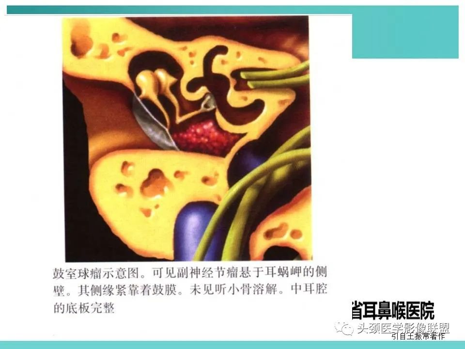 影像PPT - 【PPT】慢性中耳乳突炎-98