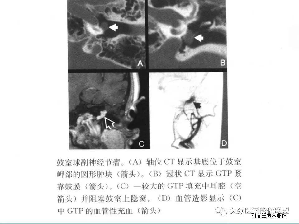 影像PPT - 【PPT】慢性中耳乳突炎-99