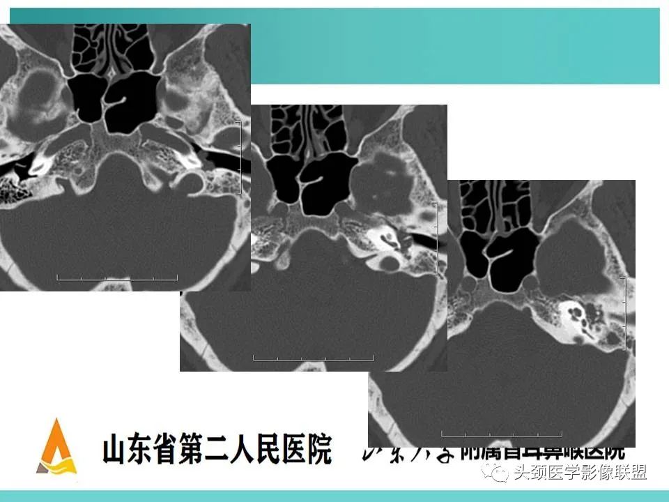 影像PPT - 【PPT】慢性中耳乳突炎-100