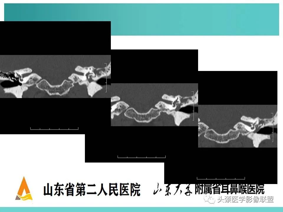 影像PPT - 【PPT】慢性中耳乳突炎-102