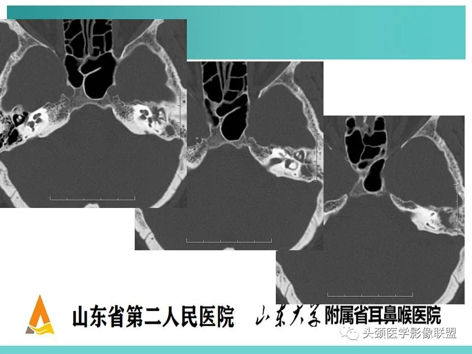 影像PPT - 【PPT】慢性中耳乳突炎-101