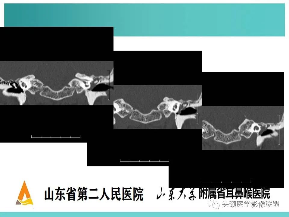 影像PPT - 【PPT】慢性中耳乳突炎-103