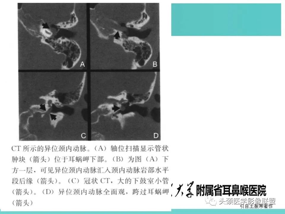 影像PPT - 【PPT】慢性中耳乳突炎-109