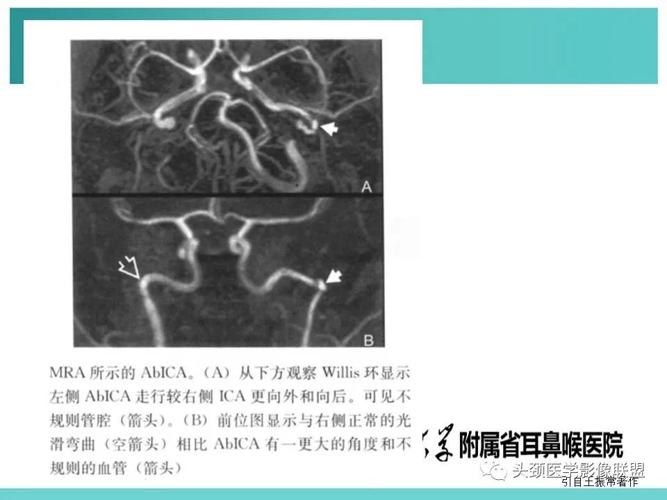 影像PPT - 【PPT】慢性中耳乳突炎-110