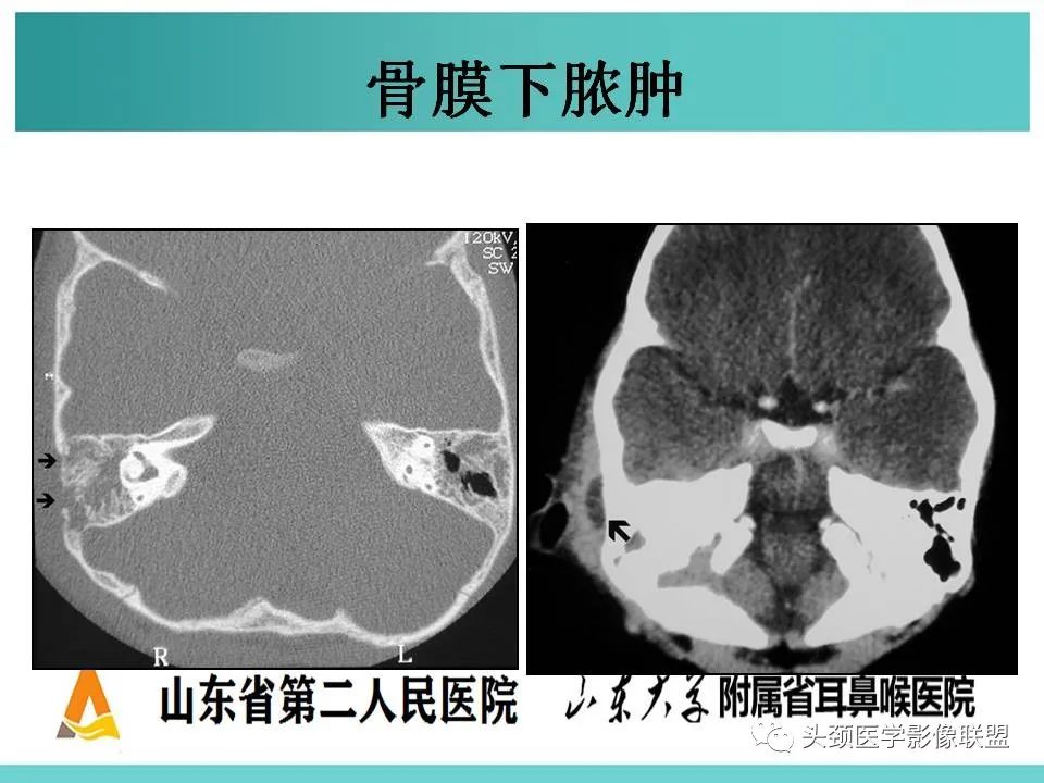 影像PPT - 【PPT】慢性中耳乳突炎-114